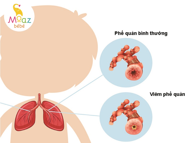 Dấu hiệu viêm phổi bố mẹ cần biết 