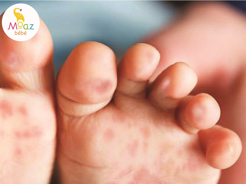 Bệnh tay chân miệng ở trẻ em các mẹ cần chú ý điều gì?