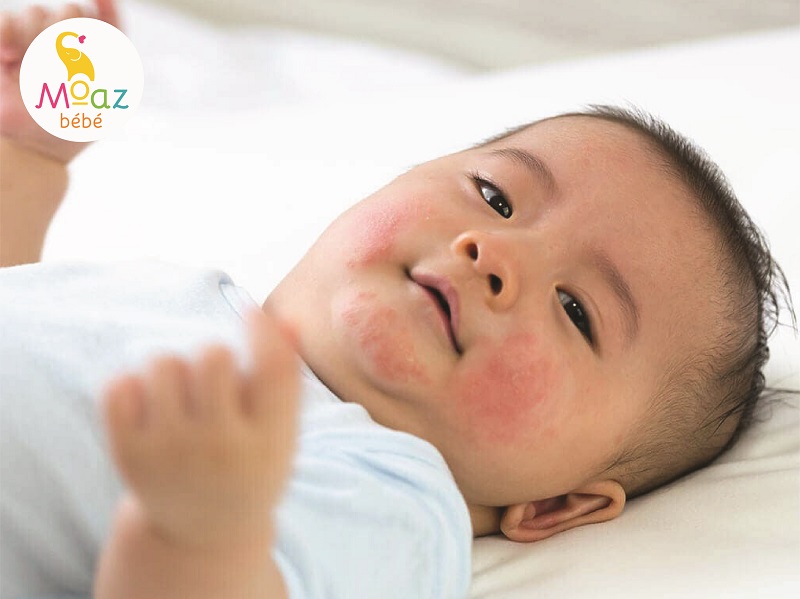Bệnh rôm sảy ở trẻ em khi chăm sóc các mẹ cần lưu ý những gì? 2 Bệnh thường gặp khi thời tiết năng nóng