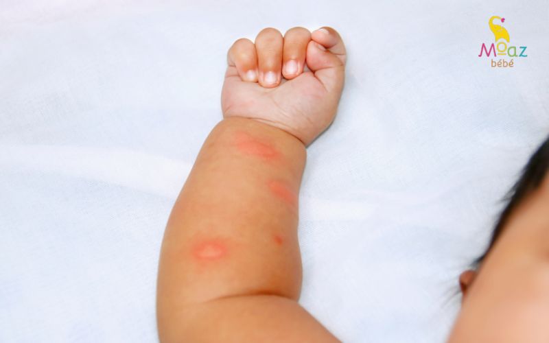 Trẻ có dấu hiệu xuất huyết dưới da