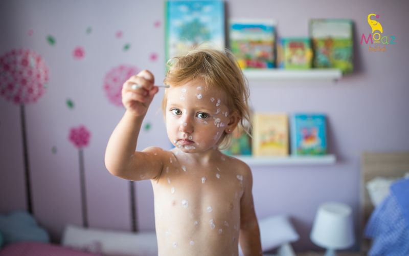 Bệnh thủy đậu trẻ em có thể để lại sẹo ảnh hưởng đến tính thẩm mỹ