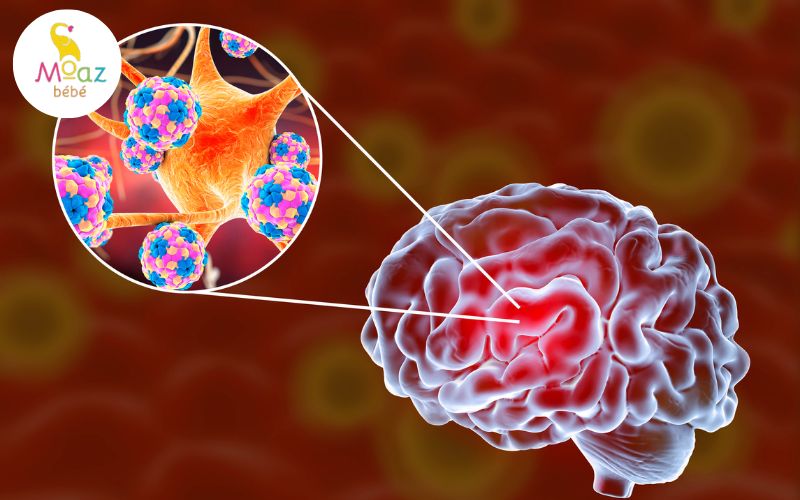 Viêm màng não do vi khuẩn gây nhiều biến chứng nguy hiểm