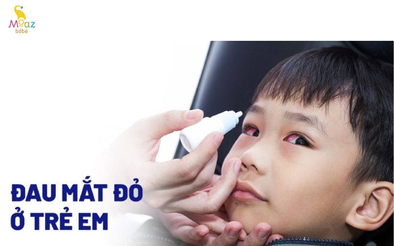 Bệnh đau mắt đỏ ở trẻ em rất nguy hiểm