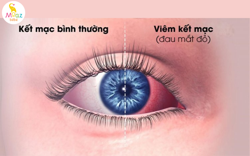 Phân biệt mắt bị đau mắt đỏ và mắt khỏe mạnh