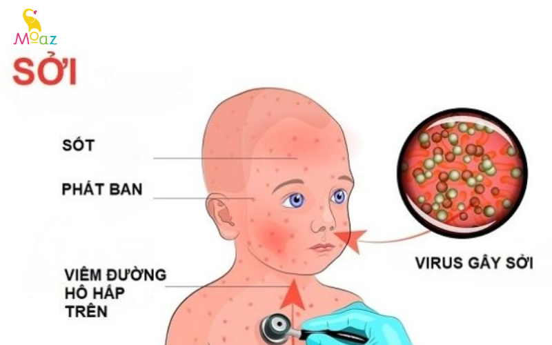 Virus sởi xâm nhập vào cơ thể gây sốt, phát ban, viêm đường hô hấp ở trẻ