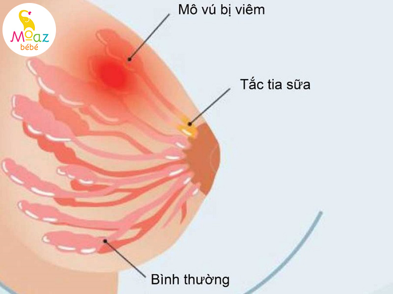 Tắc tia sữa hút không ra