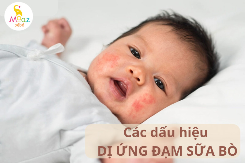 Các dấu hiệu bị dị ứng đạm sữa bò dễ nhận biết