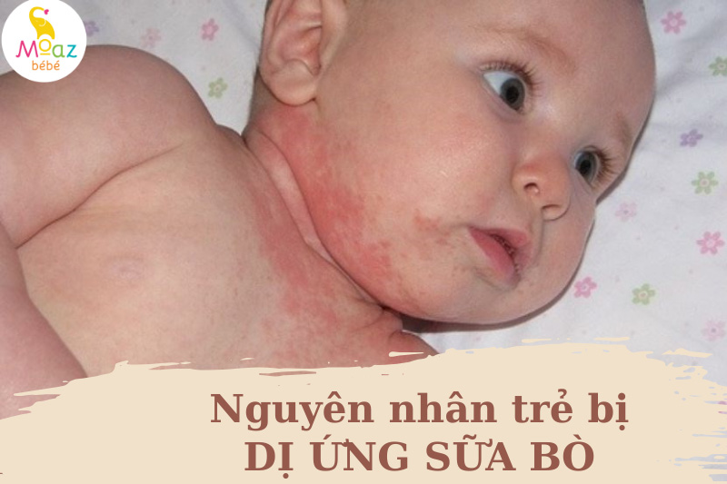 Nguyên nhân dị ứng đạm sữa bò