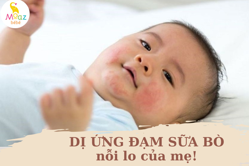 dị ứng đạm sữa bò