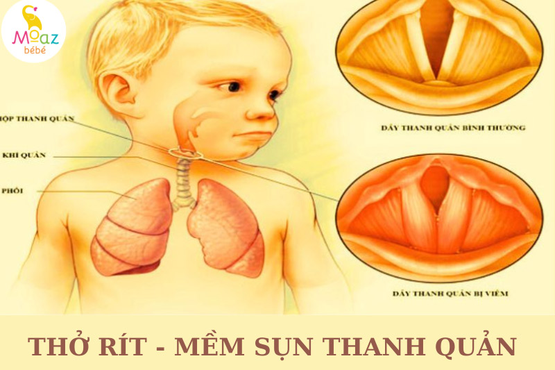 Trẻ sơ sinh bú có tiếng rít có nguy hiểm không?