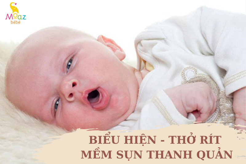 Thở rít là biểu hiện cảnh báo mềm sụn thanh quản