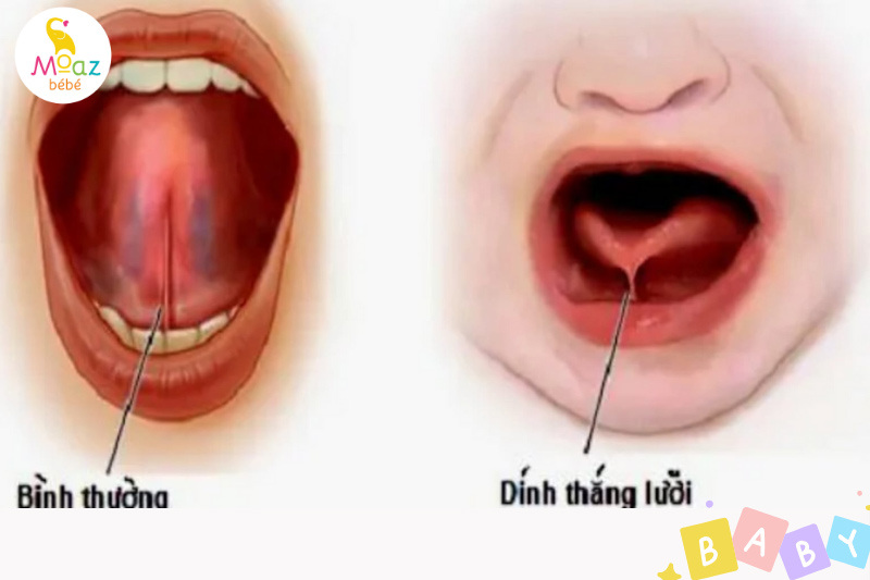 Trẻ quấy khóc, giãy giụa khi bú bình nguyên nhân do đâu?