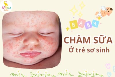 Chàm sữa ở trẻ sơ sinh là gì? 