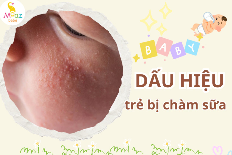 dấu hiệu dễ nhận biết trẻ bị chàm sữa