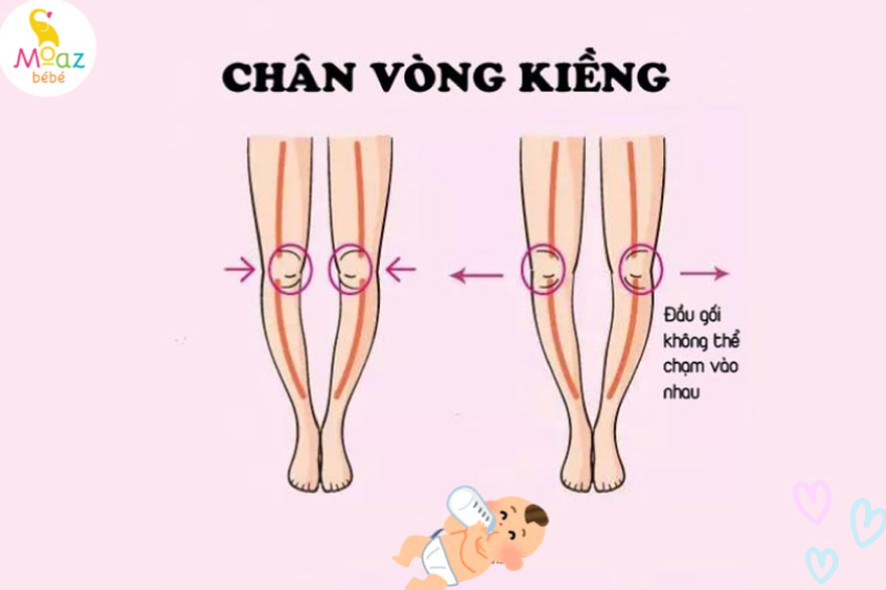 Chân vòng kiềng là gì? 