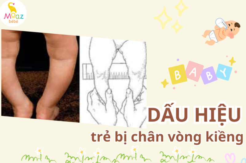 Dấu hiệu nhận biết trẻ bị chân vòng kiềng dễ nhất 