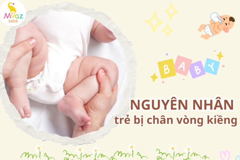 Nguyên nhân khiến trẻ bị chân vòng kiềng