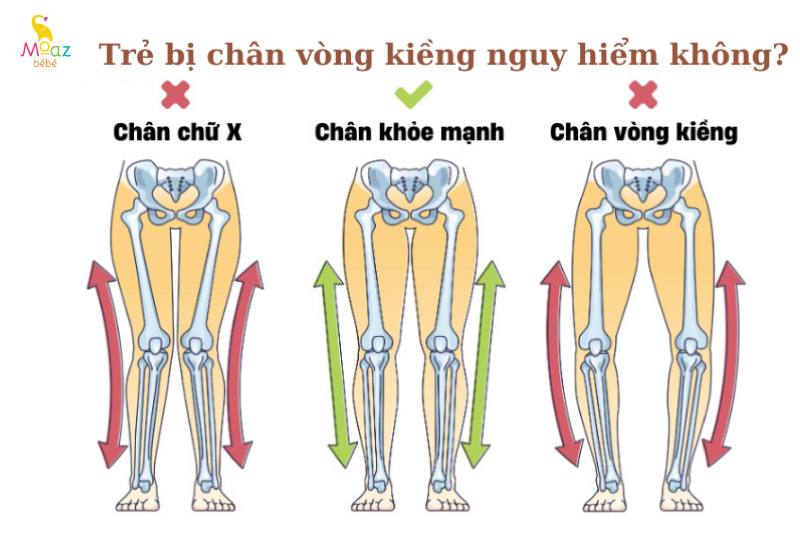 Trẻ bị chân vòng kiềng có nguy hiểm không? 