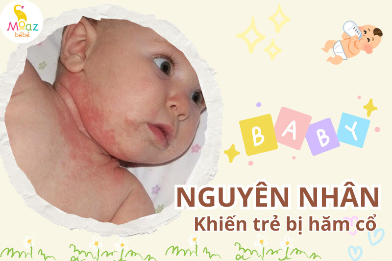 Nguyên nhân khiến trẻ bị hăm cổ nổi mụn 