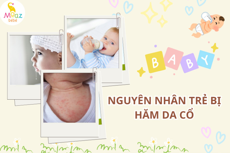 Nguyên nhân khiến trẻ bị hăm cổ nổi mụn 