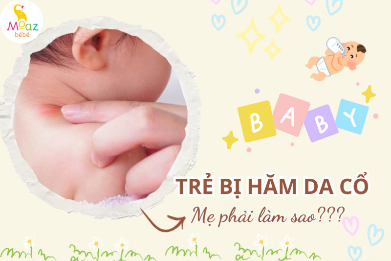 Trẻ bị hăm cổ nổi mụn phải làm sao? 