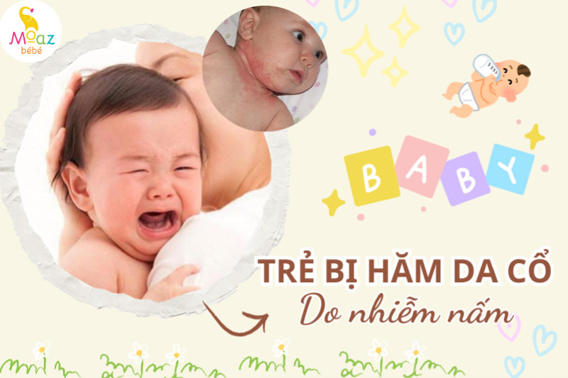 Trẻ bị hăm cổ nổi mụn phải làm sao? 