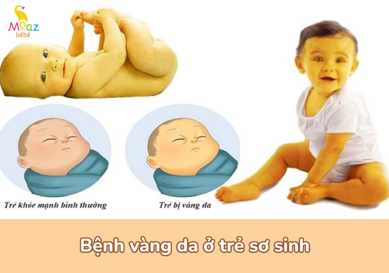 Bệnh vàng da ở trẻ sơ sinh