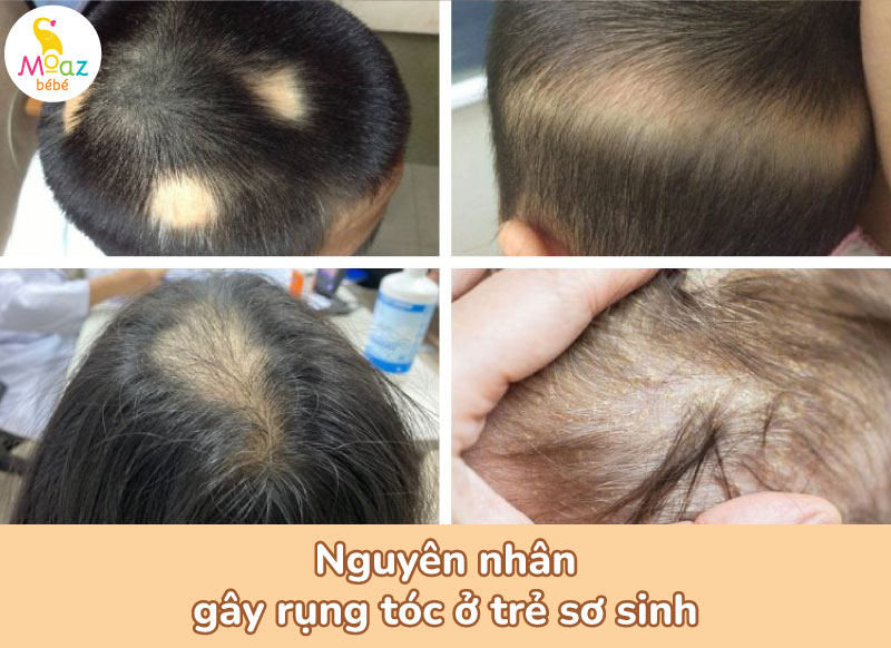 nguyên nhân rụng tóc vành khăn