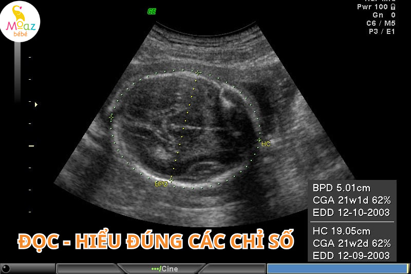 Tại sao mẹ bầu cần hiểu đúng các chỉ số trong siêu âm thai?
