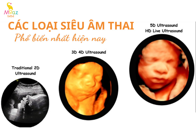 Có bao nhiêu loại siêu âm thai?