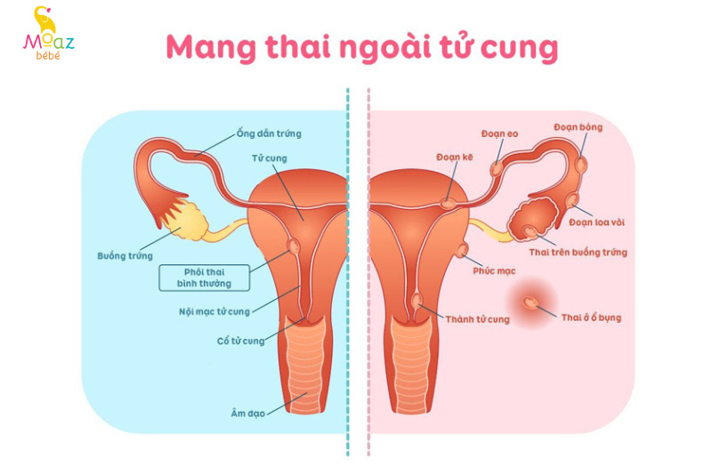 Nguyên nhân siêu âm không thấy thai dù trễ kinh 20 ngày