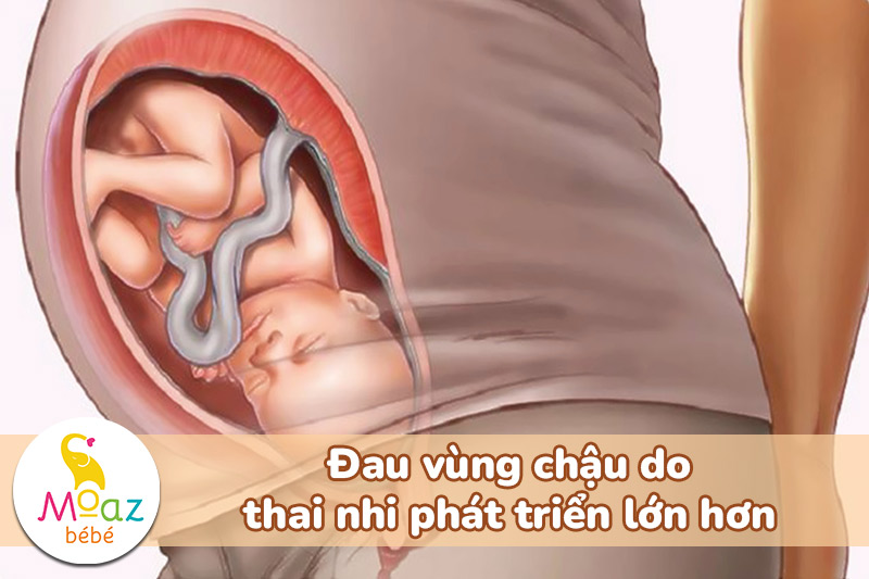 Đau vùng chậu do thai nhi phát triển lớn hơn