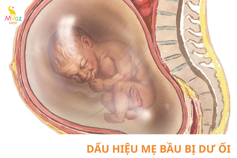 Dấu hiệu nhận biết mẹ bầu bị dư ối