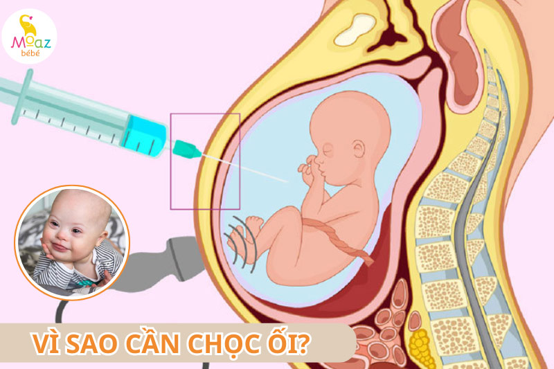 Vì sao cần chọc ối?