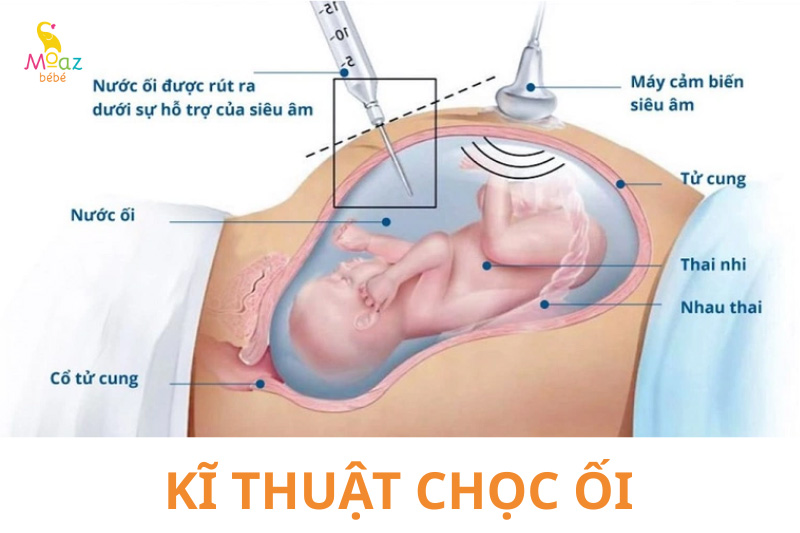 Kỹ thuật chọc ối được thực hiện như thế nào?