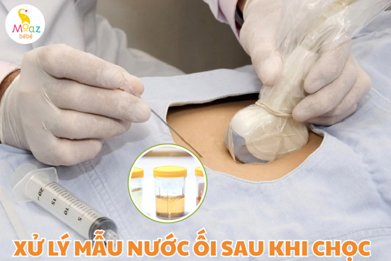 Mẫu nước ối sau khi chọc được xử lý ra sao?