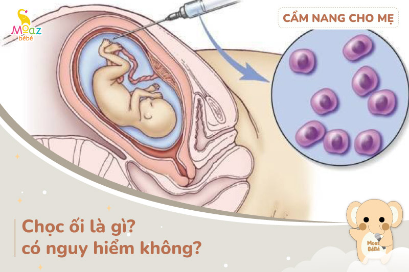 Tìm hiểu chọc ối là gì?