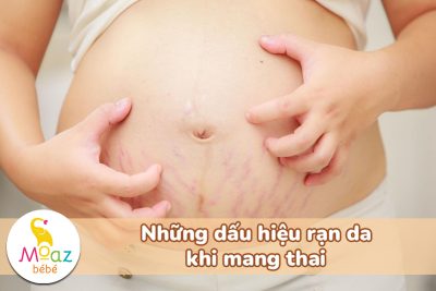 Dấu hiệu rạn da khi mang thai