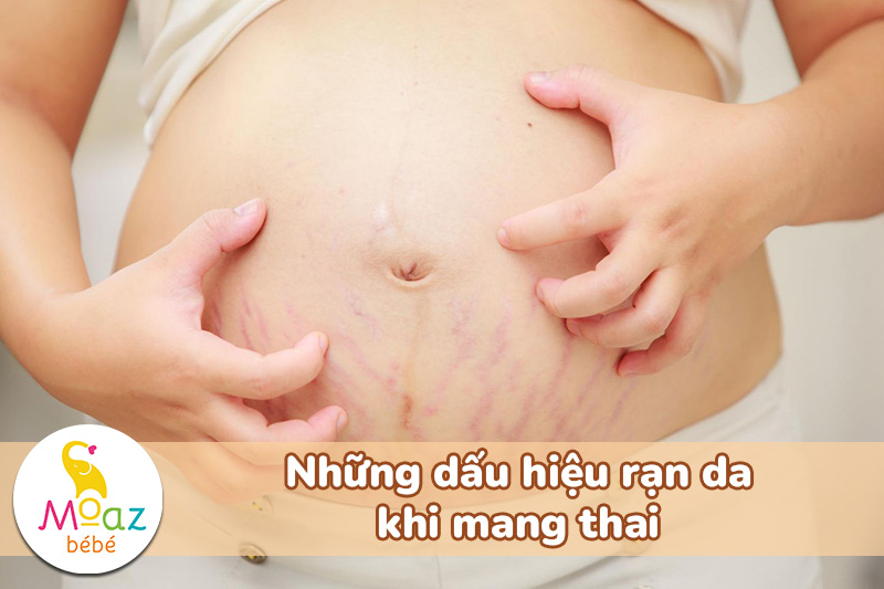 Dấu hiệu rạn da khi mang thai