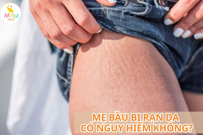 Mẹ bầu bị rạn da có nguy hiểm không?