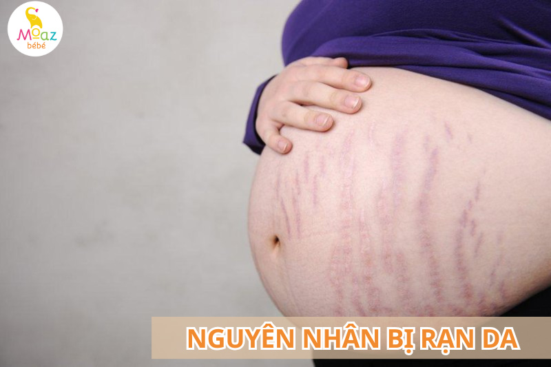 Nguyên nhân dẫn đến rạn da khi mang thai