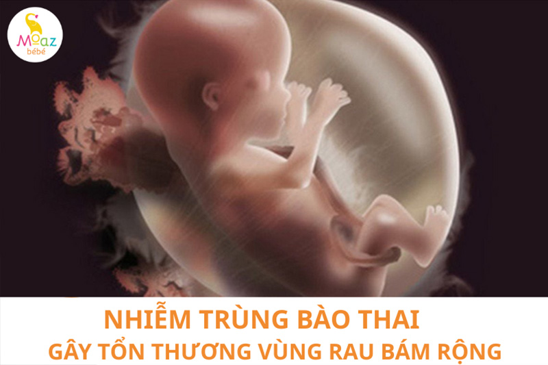 Mối quan hệ của rau bám diện rộng và nhiễm trùng bào thai