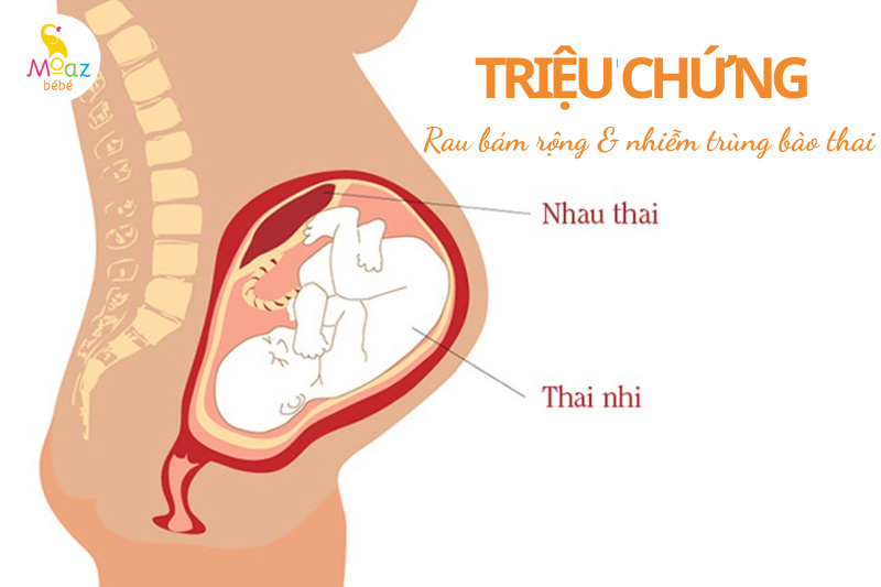 Triệu chứng rau bám diện rộng