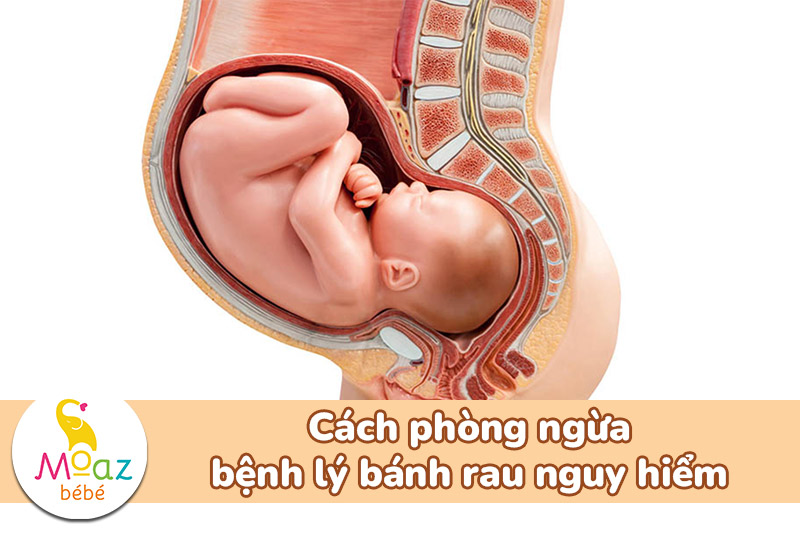 Cách phòng ngừa bệnh lý bánh rau nguy hiểm