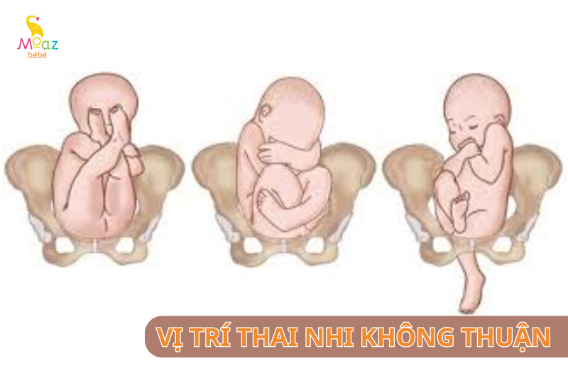 Các vị trí thai nhi trong bụng mẹ không thuận lợi