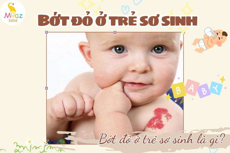 bớt đỏ ở trẻ sơ sinh là gì?