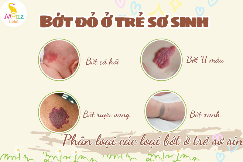 Hướng dẫn cách xử lý vết bớt ở trẻ sơ sinh