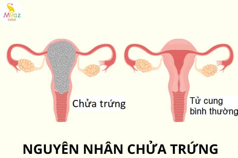 Nguyên nhân mẹ bầu chửa trứng