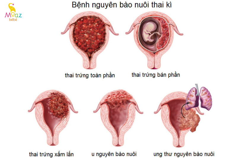 Chửa trứng có nguy hiểm không?