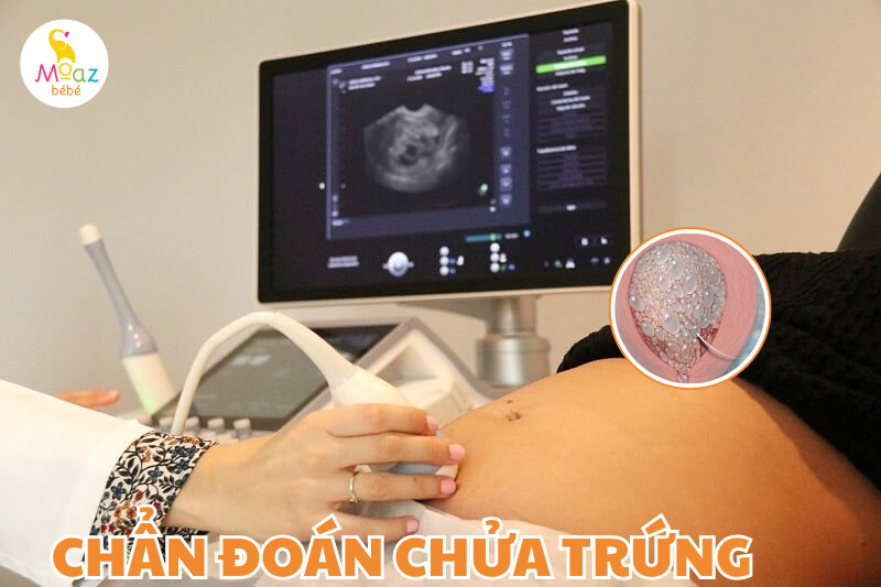Cách chẩn đoán chửa trứng